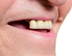 歯を失ってしまった方へ