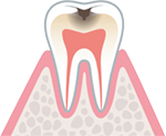 象牙質の虫歯