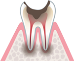 歯根に達した虫歯