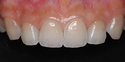 オールセラミック