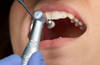 歯垢・歯石の除去